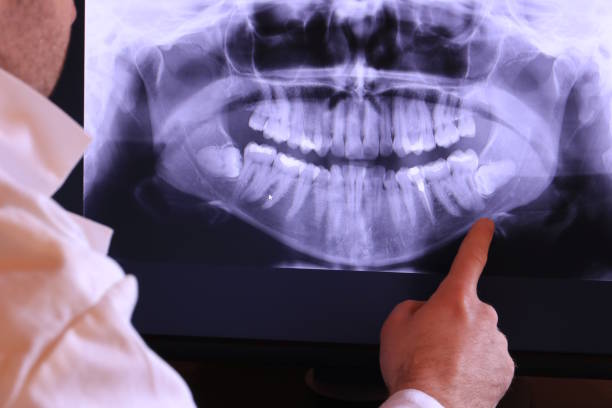 Best Emergency Wisdom Teeth Removal in Blue Mountain, MS